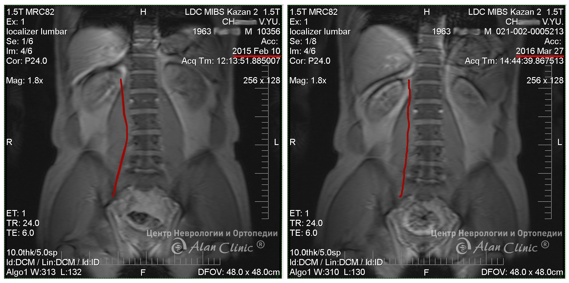 Остеохондроз поясничного отдела позвоночника, Секвестрированная грыжа диска, протрузия диска. Фото до и после лечения