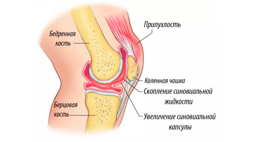Жидкость в коленном суставе (выпот) — Лечение в «Алан Клиник» Казань