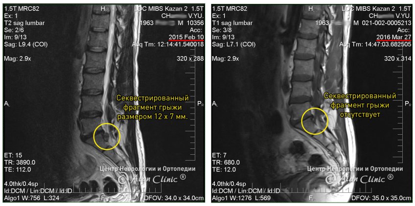 Остеохондроз поясничного отдела позвоночника, Секвестрированная грыжа диска, протрузия диска. Фото до и после лечения