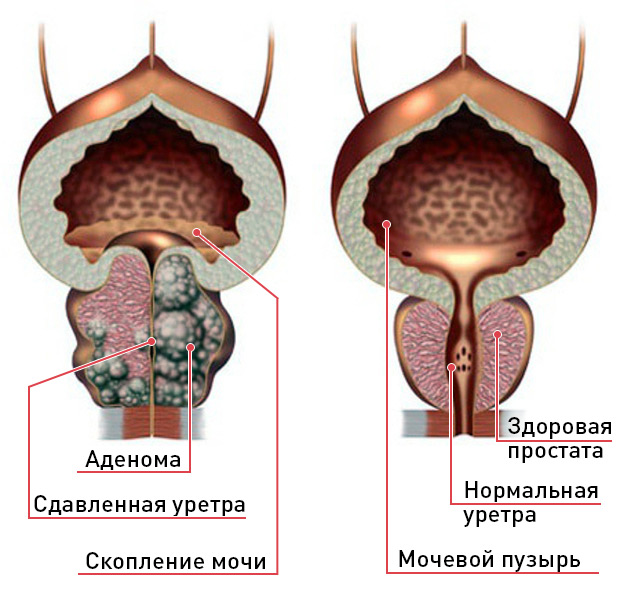 Что происходит при аденоме простаты, лечение аденомы в «Алан Клиник» Казань